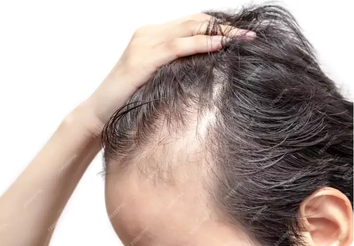 Hair Loss