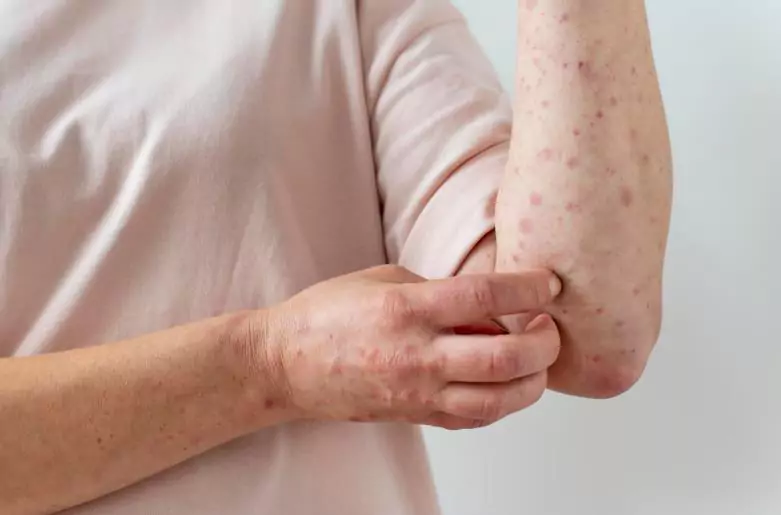 Skin Diseases